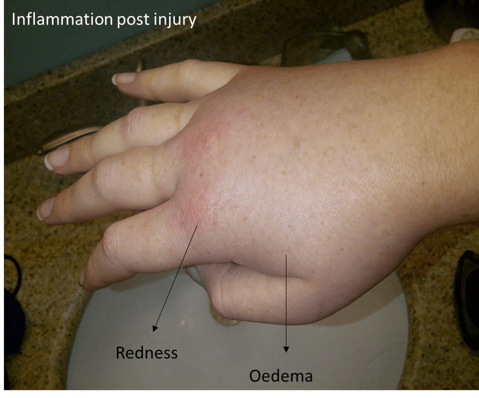 swelling post injury