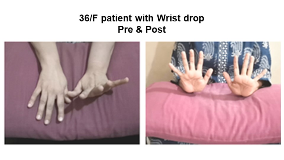 Before-and-after photos of a patient with wrist drop. On the left, her hand shows difficulty in extension. On the right, her hand appears improved post treatment