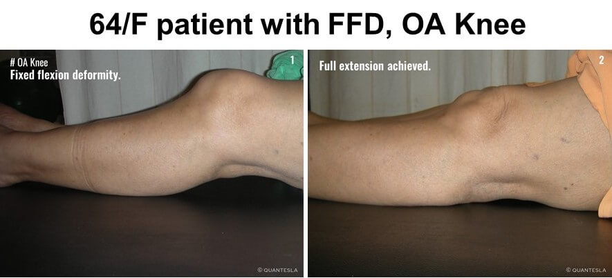 Patient with osteoarthritis and fixed flexion deformity before and after receiving advanced physiotherapy treatment