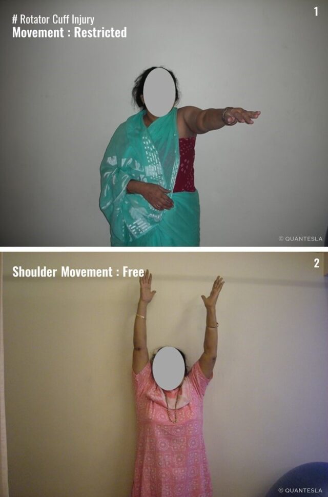 Before and after physiotherapy treatment photos showing restricted shoulder movement and improved after receiving advanced physiotherapy