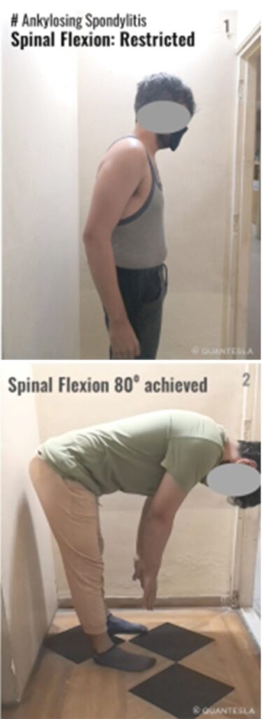 28-year-old male patient with Ankylosing Spondylitis showing restricted spinal flexion before treatment and achieving 80 degrees of spinal flexion after advanced physiotherapy, including Celtron with Magneto-Mechanical Oscillations