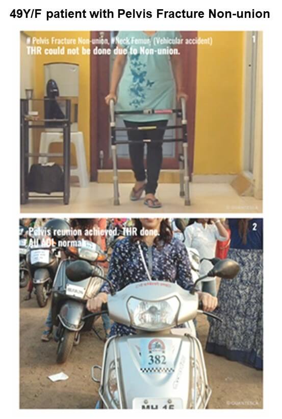 Pre and post result of pelvis fracture non-union